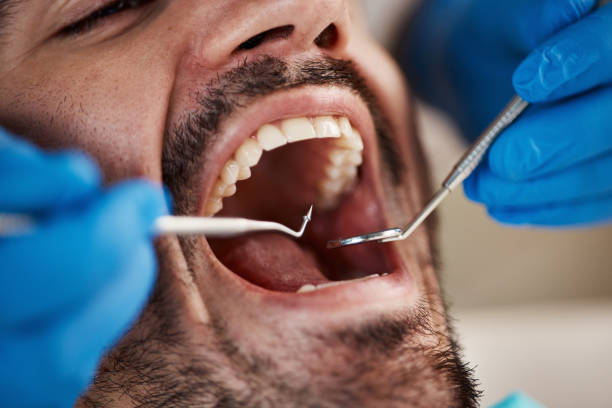 Best Emergency Dental Care for Broken or Chipped Teeth in Strongsville, OH